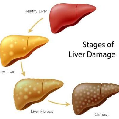 What are the causes of liver failure Know its symptoms and remedies